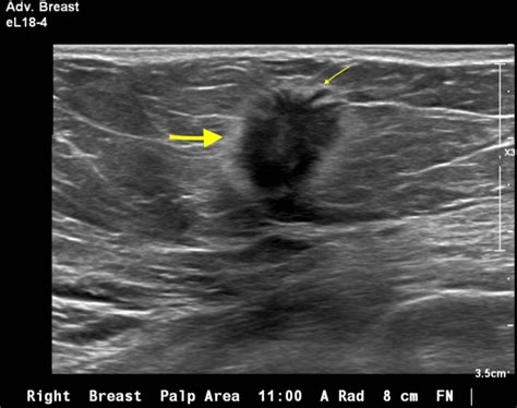 Ultrasound Guided Breast Biopsy A Complete Course Institute For