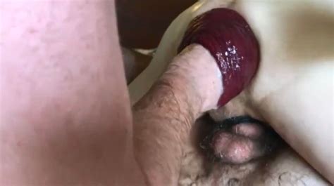 Really Shocking Sized Amateur Anal Prolapse Ever Seen In Hd P
