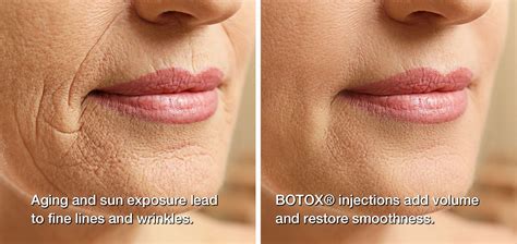 Top Reasons To Choose Botox Marielaina Perrone Cosmetic Dentist