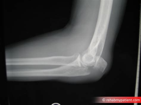 Elbow X Ray Fracture