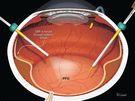 Vitrectomy For Retinal Detachment Ento Key