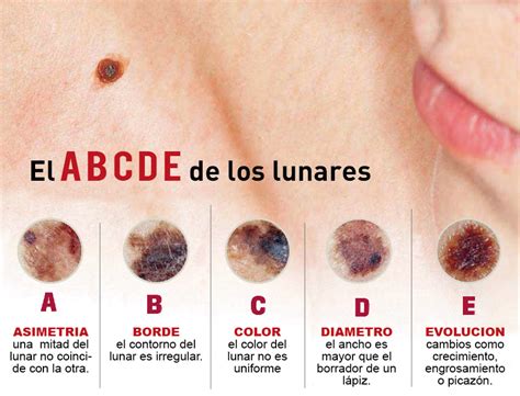 Controles Sin Turnos Y Gratuitos Semana De La PrevenciÓn Del CÁncer De