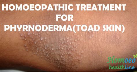 Phrynoderma Toad Skin And Homoeopathic Treatment
