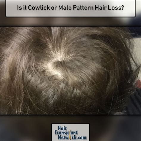 Many of my friends in the 60s are complaining. How common are #Cowlicks? How can you tell if the #hair is ...