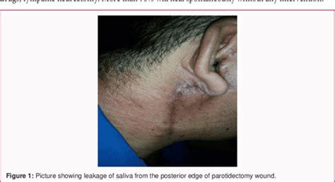 Figure 1 From Rare Parotid Salivary Fistula Post Superficial
