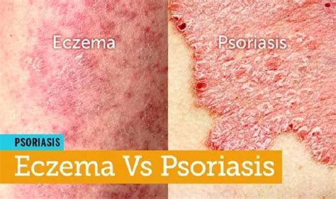 Scalp Eczema Vs Psoriasis