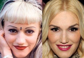 Gwen Stefani Did She Have Plastic Surgery Blog Clinic Center