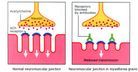 Myasthenia gravis is a chronic autoimmune neuromuscular condition that causes muscle weakness and severe fatigue. Diagnostic Assays | UBC Neuro-Immunology
