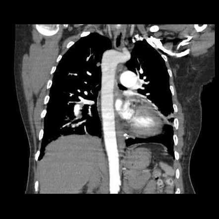 Right Aortic Arch With Aberrant Left Subclavian Artery Radiology Case