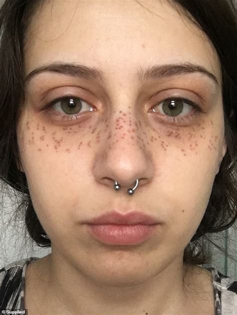 Woman Obsessed With Meghan Markle Style Freckles Left With Red Scars After Botched Permanent