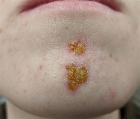 17 Common Skin Rashes In Children Dailyhealthtips