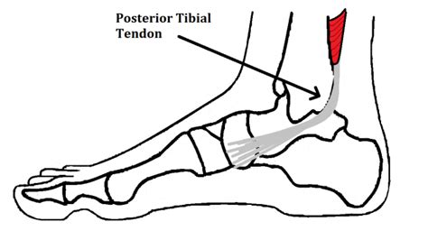 Insertional Tibialis Posterior Tendonitis Ankle Foot And Orthotic Centre