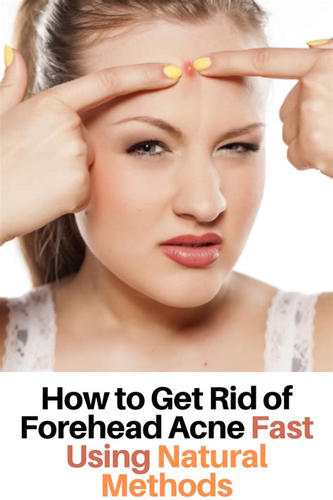 How To Get Rid Of Forehead Acne Fast Using Natural Methods