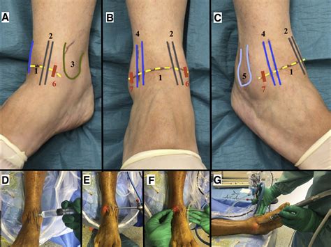 Fibular Intra Articular Resection During Arthroscopic Ankle Arthrodesis