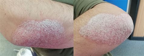 Psoriasis Plaques On The Elbows And Lateral Aspect Of Both Forearms