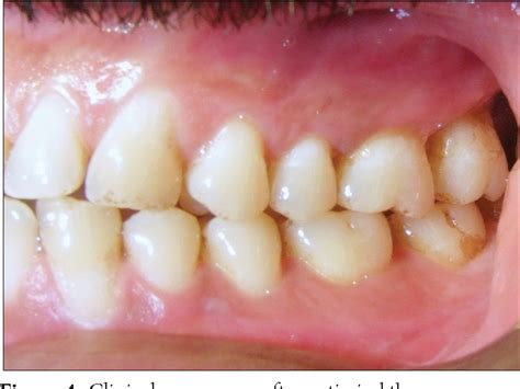 Herpetic gingivostomatitis is often the initial presentation during the first (primary) herpes simplex infection. Acute herpetic gingivostomatitis associated with herpes ...