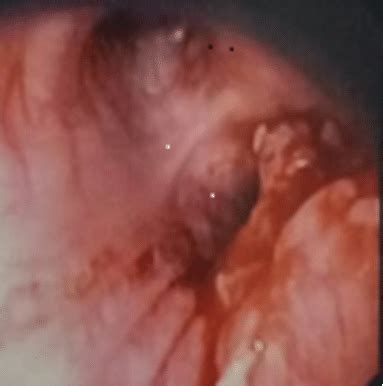 Doctors, medical centers and hospitals experts on embolia polmonare that you can contact, take appointment or send examination results. Computed tomography (CT) of the thorax in coronal views ...
