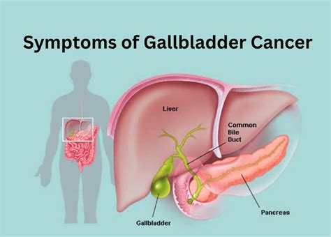 10 Advance Stage Symptoms Of Gallbladder Cancer