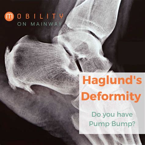 Haglunds Deformity Causes Symptoms And Diagnosis