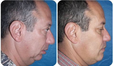 Before And After Case 2b Sleep Apnea Surgery Dr Larry M Wolford Dmd
