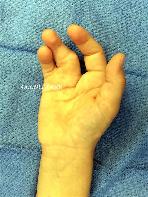 Cleft Hand Reconstruction Congenital Hand And Arm Differences