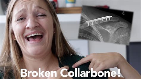 I Broke My Collarbone And Then Went Geocaching Youtube