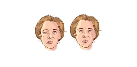 What Chiropractic Patients Want To Know About Bells Palsy Female
