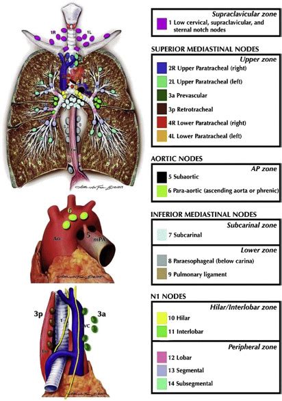 Lung Cancer Staging Thoracic Key