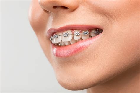 Dental Braces Types Procedure Benefits Costs