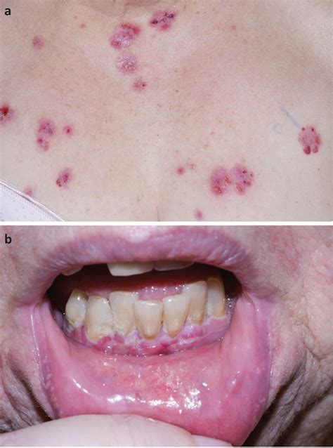 Images Of The Month Gliptin Induced Bullous Pemphigoid Rcp Journals