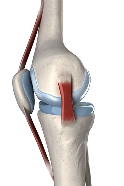 Medial Collateral Ligament Injury Knee Ligament Sprain Knee Physio