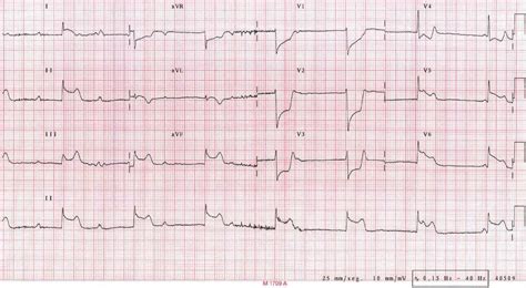 The pain from variant angina is caused by a spasm in the coronary arteries (which supply blood to the. Espasmo coronario secuencial en angina variante de ...