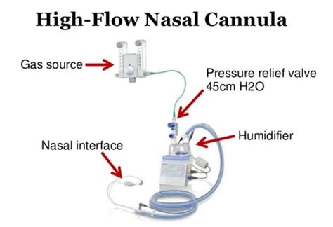 High Flow Nasal Cannula Set Up Lupon Gov Ph