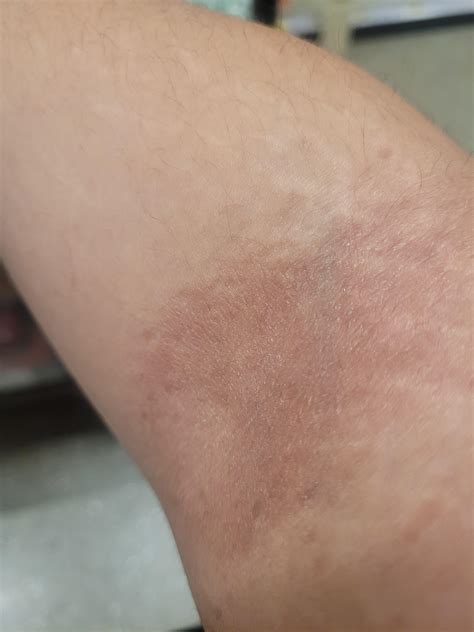 Rash On Inner Elbow Rdermatologyquestions