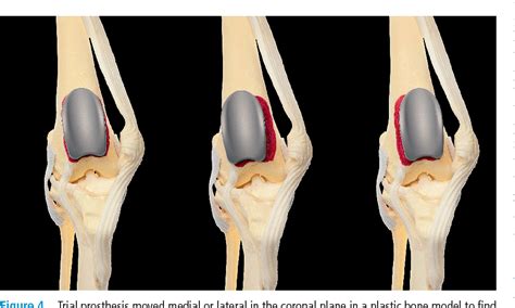 Pdf Patellar Groove Replacement In Patellar Luxation With Severe