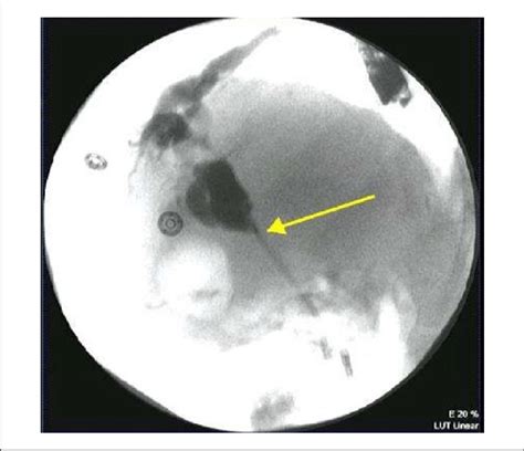 Endoscopic Retrograde Cholangiopancreatography Showing Biliary