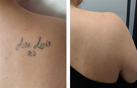 Does laser tattoo removal hurt? Laser Tattoo Removal: What You Need to Know ...