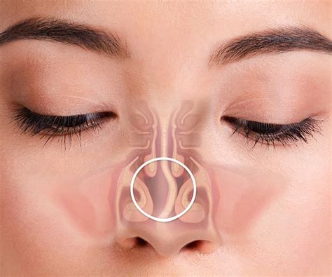 Deviated Nasal Septum Meaning Types Causes Symptoms And Treatment