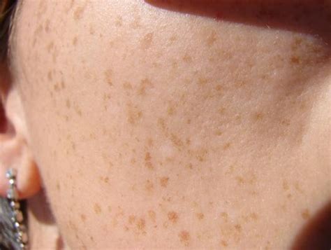 Fashion And Beauty What Are The Causes Of Brown Skin Spot