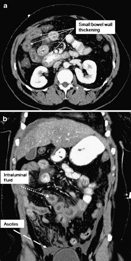 A Axial Images From Ct Scan Of The Abdomen And Pelvis With Oral And Iv