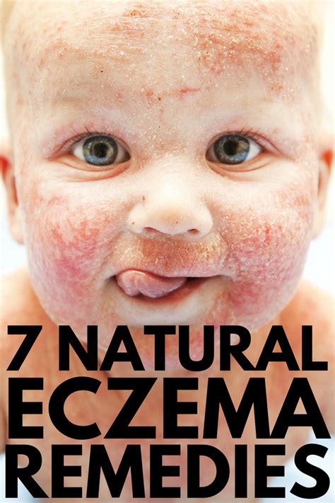 Natural Eczema Treatment 7 Natural Ways To Treat Eczema That Work