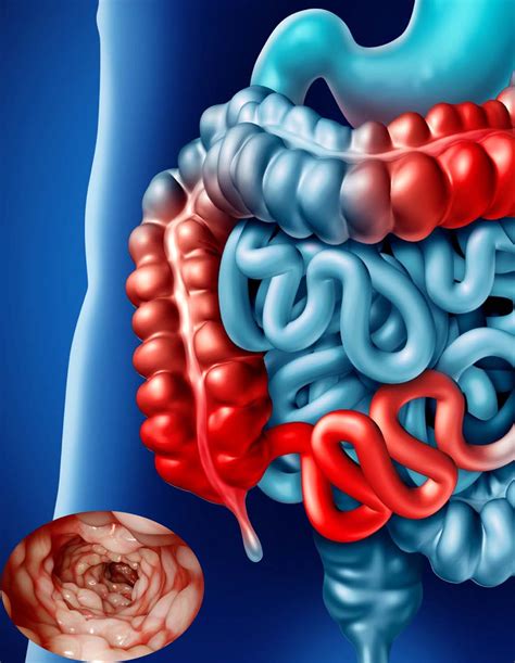 Crohns Disease The Challenge Is Separating Out Potential Causes