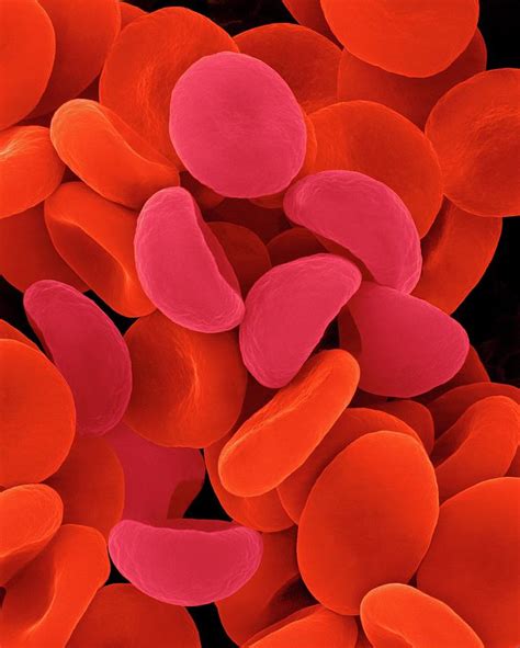 Red Blood Cells In Hypotonic Solution Photograph By Dennis Kunkel