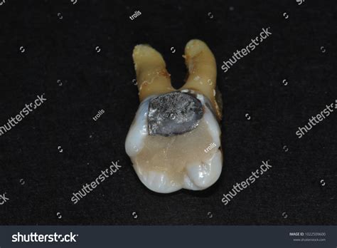 Extracted Human Molar Tooth Amalgam Glass Stock Photo 1022509600