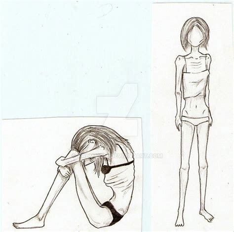 Anorexia By Kalmakim On Deviantart
