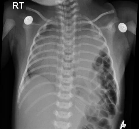 Congenital Diaphragmatic Hernia Radiology Case