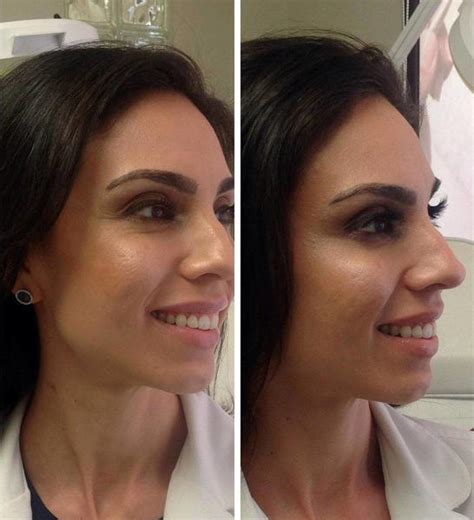Indications, dosage, adverse reactions and pharmacology. How Much Are Botox Injections In The Face? » Facelift: Info, Prices, Photos, Reviews, Q&A