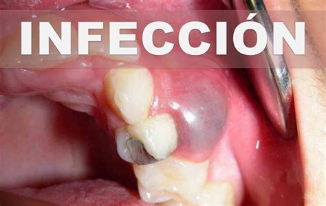 Remedios Caseros Para Un Absceso Dental Como Aliviar Infección En La