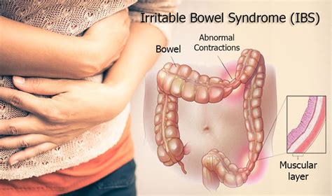 Irritable Bowel Syndrome Ibs And Its Treatment By Dr Radhika Amulraj Lybrate