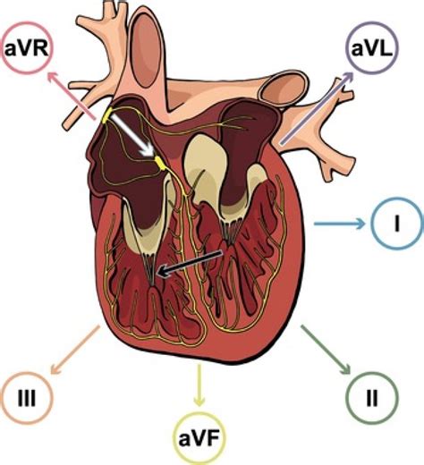 Chapter 3 Anterior Wall Myocardial Infarction Thoracic Key